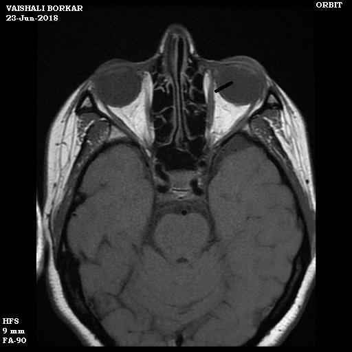 Figure 3: MRI (T2): showing hyperintense medial rectus belly.