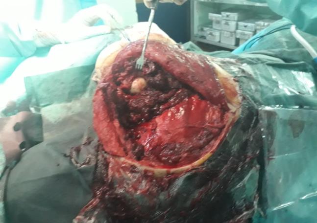 Figure 3: Scapulectomy with safe margins.
