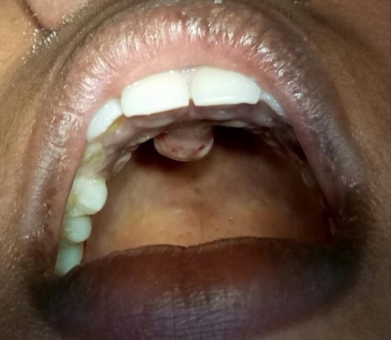 Figure 1: Surface of the swelling showing ulceration.