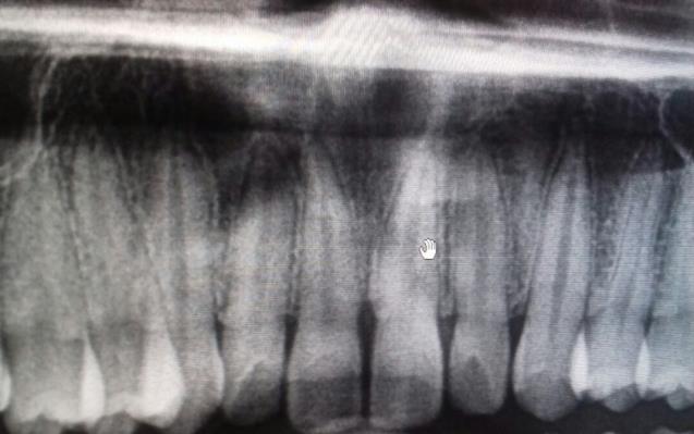 Figure 3: Panoramic radiograph showing heart shaped radiolucency between centrals.