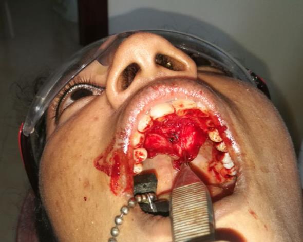 Figure 5: Enucleation of the cyst.