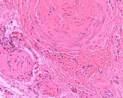 Figure 7: Histopathology of NP Cyst.