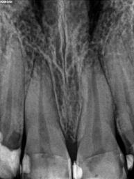 Figure 3: Initial case showing discrepancy in the width and length of the central Incisors.