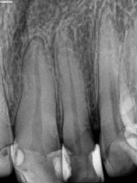 Figure 4: Mounted diagnostic wax-up on articulator for final diagnostic appearance.