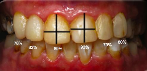 Figure 5: Restorations by composite.