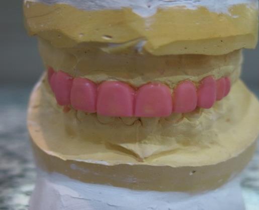 Figure 6: Final preparations; buccal view.