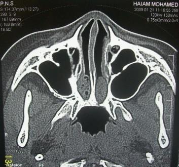 Figure 1: CT axial cut showing bilateral bony choanal atresia.