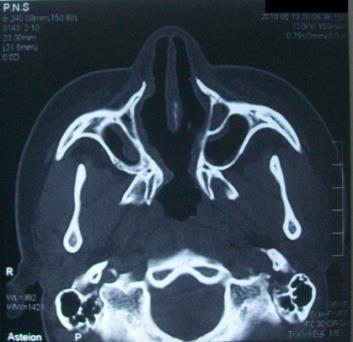 Figure 3: CT bony axial cut showing the post-operative common opening in a case of bilateral choanal atresia.