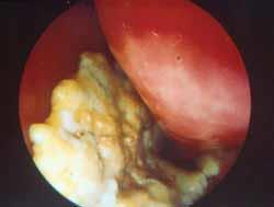 Figure 1: Rhinolith visualized by nasal endoscopy.