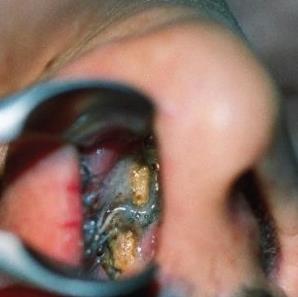Figure 3: Anterior Rhinoscopy showing rhinolith.
