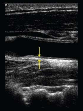 Figure 1: Measurement of carotid intima media thickness: The distance between the leading edge of the first bright line (the blood–intima interface) of the far wall and the leading edge of the second bright line (media–adventitia interface) indicates the IMT.