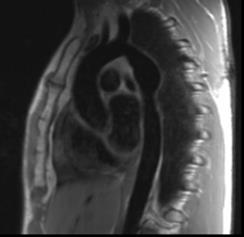 Figure 2: Illustration shows patch plastic for repair of coarctation of aorta with incision site for patch repair (dashed line).