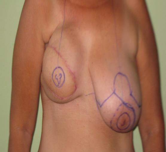 Figure 2: Postoperative period of the 1st and 2nd surgical time with reconstruction of the right breast by muscle- cutaneous flap of the latissimus dorsi, NAC by contralateral areola graft and reductive mastoplasty of the left breast.