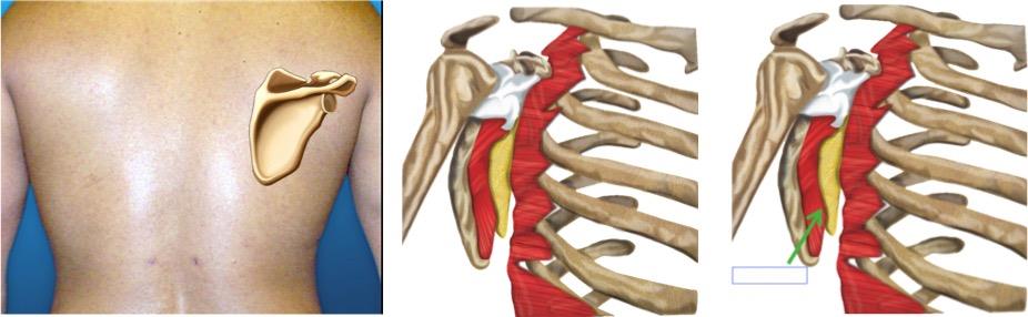 Figure 1: On physical examination, the lesion is usually well circumscribed and is not attached to the skin, however it is difficult to define it with respect to neighboring structures. Normally, when the upper limb is mobilized, the tumor shifts and becomes more palpable and / or more painful. Large tumors can simulate winged scapula by elevating it. Upon physical examination, it appears as a soft, elastic, firm, mobile, not adhered to deep tissue planes, painless mass; and without evidence of skin alterations [12]. Its size may be augmented by rotational movements of the gleno-humeral articulation. When they are large sized they may simulate a winged scapula [13,14].