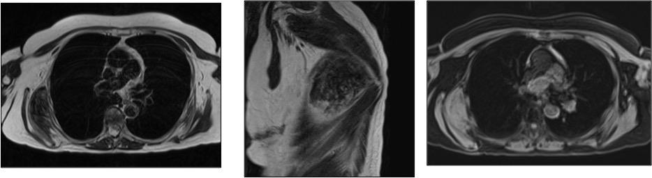 Figure 3: Axial T2: A mass is identified, with well-defined edges, relatively isointense to the muscle in T2 sequences with linear areas of high signal intensity per fatty component, located towards the lower pole of the right scapula. They are located between the thoracic wall, the anterior serratus, and the latissimus dorsum. Coronal T2: Mass is identified, with well-defined edges, relatively isointense to the muscle in T2 sequences with linear areas of high signal intensity by fat component, located towards the lower pole of the right scapula. They are located between the thoracic wall, the anterior serratus, and the latissimus dorsum. Axial T1 fat sat: Mass of well defined edges, predominantly hyperintense in T1 fat sat sequences, with some hypointense areas in relation to small foci of fat, located towards the lower pole of the right scapula.