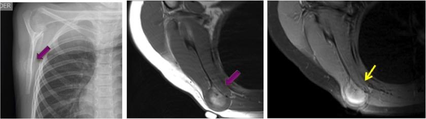 Figure 6: Osteochondroma. A 7-year-old patient who consulted for a non-painful mass in the right scapular region. Simple lateral projection of scapula; radiopaque image, nodular dependent on the body of the right scapula, with smooth and defined edges. T1; with scapular-dependent nodular body image of intermediate intensity. T2 contrasted with fat saturation; with hyperintense image, which increases with contrast enhancement, with peripheral band that could correspond to perichondrium.
