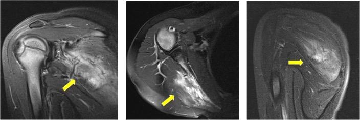 Figure 7: Male patient of 8 years with painful right scapular mass of rapid growth. Bx was performed that reported soft tissue sarcoma. Magnetic resonance t1 with greasy saturation and contrast: Highly vascularized mass infiltrating the supra and infraspinatus that corresponds to a rhabdomyosarcoma.