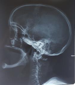 Figure 2: Skull x-ray: incomplete "cookie cutter" lesions characteristic of multiple myeloma.