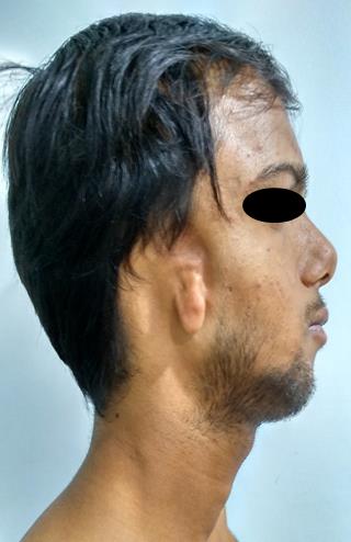 Figure 3: CT Image howing hypoplatic mandible on right side with temporomandibular joint abnormality and hypoplastic condyle and body of mandible on right side.
