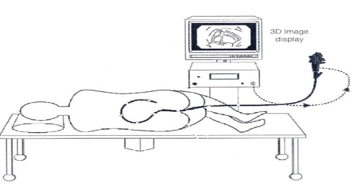 Figure 1: Most colonoscopists place the patient in the left lateral position for the procedure [7]. The equipment to perform the procedure involves a colonoscope (scope), light source, connections for suction and water, and a monitor, displaying the luminal view of the colon obtained from the scope tip. A control stand powers the scope functions, and projects the image collected from the scope onto the monitor.