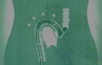 Figure 3: a) Normal Colon; b) Alpha loop colon; c) Gamma loop colon [5].