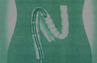 Figure 4: The formation of a loop.