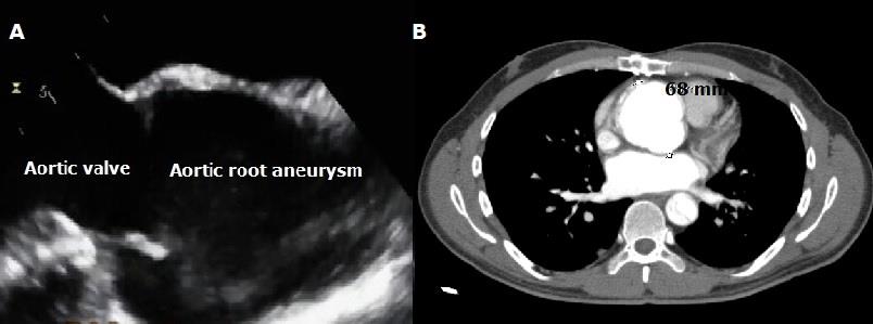 Figure 1: Echocardiographic and computed tomographic images in a patient with ascending aortic aneurysm diagnosed and operated under elective conditions.