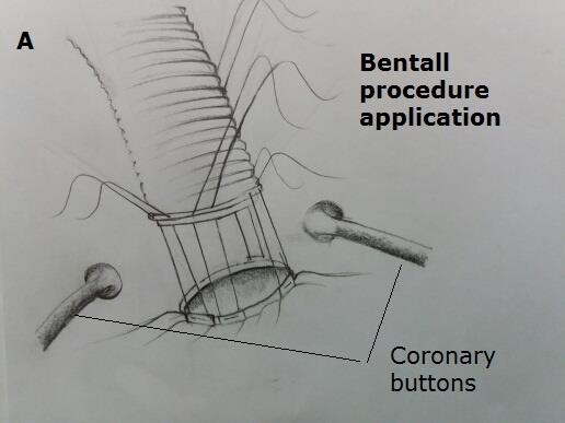 Figure 4: Schematic drawing showing ascending aortic + root replacement with Bentall procedure.