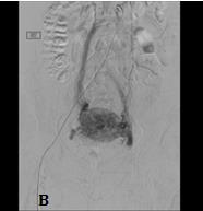 Figure 1: A: Abdominal and pelvic angiogram showing hypervascularity of uterine arteries.