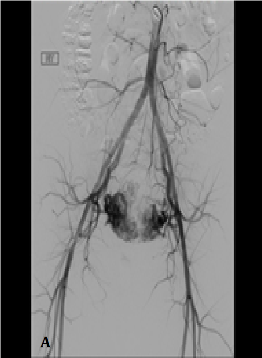 Figure 3: Multiple sagittal contrast-enhanced pelvic MR show multiple large serpentine abnormal vesselsa along the endometrial cavity that extend into the myometrium (white arrow in A, B and C).