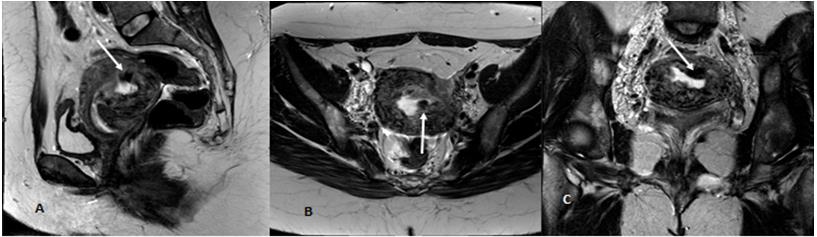 Figure 4: Sagittal (A) T2-wieatghed image, Axial (B) T1-wieatghed image post contrast and (C) subtraction of the pelvis at the level of the uterus post treatment show normalized zonal anatomy of the uterus with disappear of the multiple large serpentine endometrial vessels (white star in A, B and C).