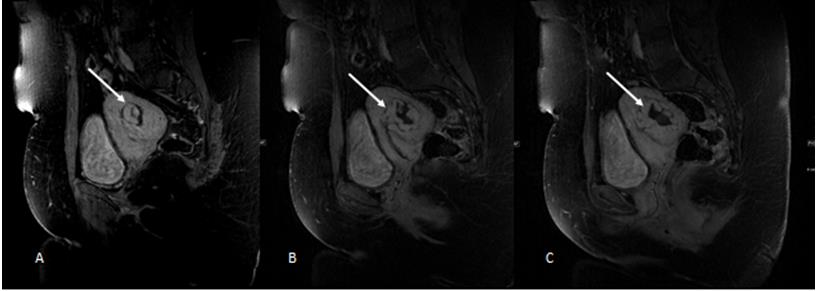Figure 5: Sagittal A, B and coronal C Contrast-enhanced MR angiography of pelvic show multiple large serpentine abnormal vessels arising from bilateral internal illac vessels (white arrow in A, B and C).