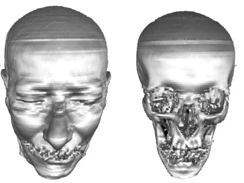 Figure 3: Illustration of the 3D risk visualization of surgical access using a hemisphere surface.