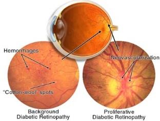 Figure 1: Classification of Retinopathy.