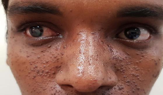 Figure 2: Iris Coloboma.