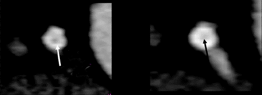 Figure 12: Multiplanar reformat image showing LAD with stent in the proximal part. A step artifact was seen distally mimicking a stenosis segment (arrow). The linear step Artifact was seen across the LV wall (solid arrow) continuing with the step in the LAD Stenosis (arrow) of the same patient.
