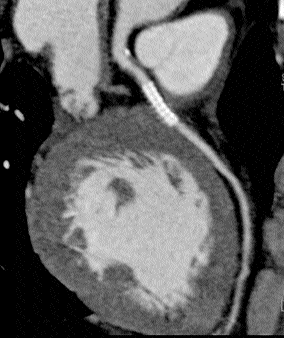 Figure 13: Multiplanar reformat image of the same patient taken in another phase shows normal distal part of the LAD without any step artifact.