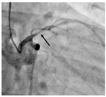 Figure 8: MIP image of LAD showing a high grade stenosis underneath the calcified plaque (arrow).