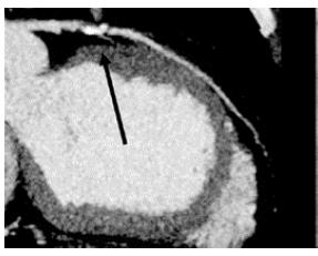 Figure 9: Angiogram showing high grade stenosis of LAD of the same patient.