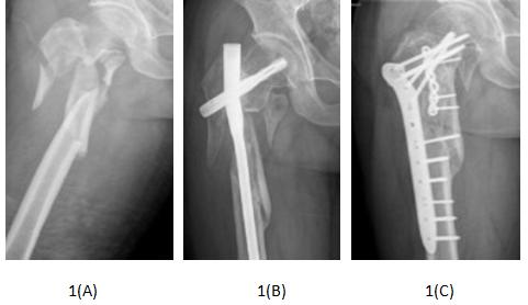 Figure 1: One patient suffered nail failure. 1(A): X-ray shows a serious fracture displacement and free medial femoral fracture fragment. 1(B): Fracture non-union and PFNA failure happened after long PFNA. 1(C): Bone union was achieved after locking plate revisionand autogenous iliac bone grafting.