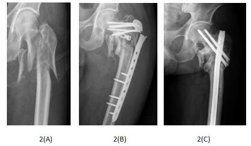 Figure 2: One patient suffered plate failure. 2(A): X-ray shows serious fracture displacement 2(B): Fracture non-union and fixation failure happened after locking plate and reconstruction plate 2(C): Bone union was achieved after long reconstruction nail revision and autogenous iliac bone grafting. The results obtained from the two groups were compared and analysed, and only intraoperative bleeding showed significant difference (P < 0.05), whereas the
