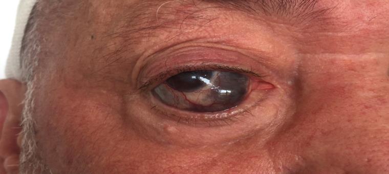 Figure 1: Scleromalacia perforans lesion of the right eye.