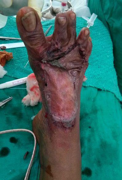 Figure 10: Figure showing post burn contracture of distal forefoot with contracture over toes in case 3 with flap marking.