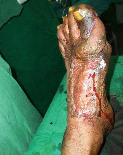 Figure 4: Final inset of flap with skin graft over donor site.