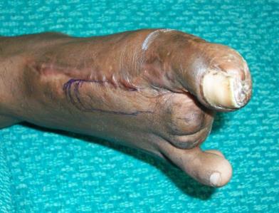 Figure 6: Figure showing defect right great toe of case 2.
