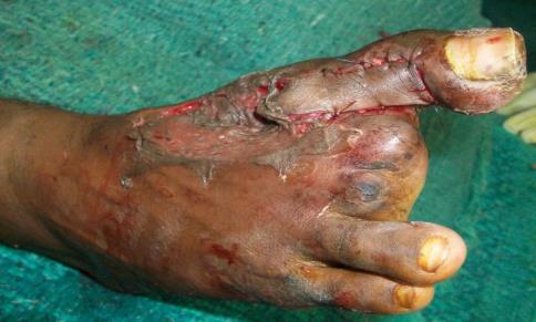 Figure 9: Final inset of flap with skin graft over donor site.