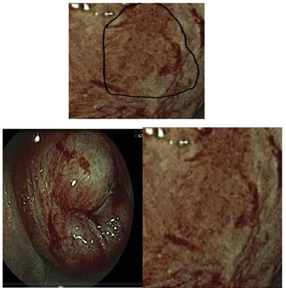 Figure 10: Figure 10: Black point it must different from gland occlusion by malignant.
