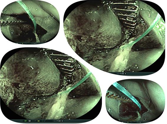 Figure 11: Metaplastic cells must be difference from dysplasia.