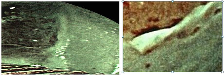 Figure 7: nabathion cyst by 3 image showing increased density of capillaries and thickness of mucosa.