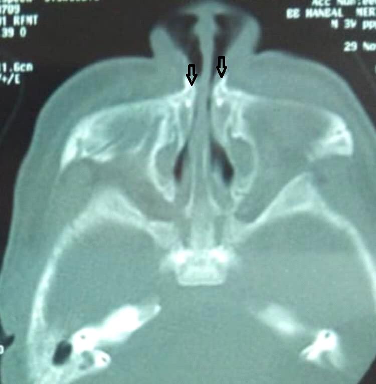 Figure 1: Axial CT scan shows medial approximation of the nasal processes of the maxilla (arrows) causing marked pyriform aperture narrowing.